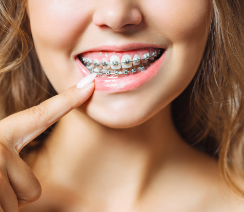 Close-up of a smiling mouth with metal braces on the upper teeth as a finger points to them.