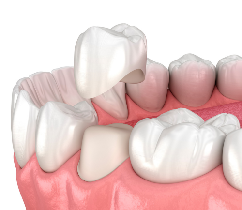 3D illustration of a dental crown being placed onto a prepared molar in the upper jaw, with adjacent teeth and pink gums.