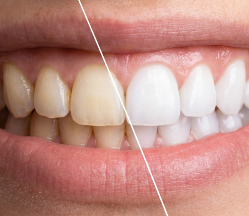 Close-up of a smile showing a before-and-after whitening comparison: yellowish left teeth and white right teeth split by a diagonal line.